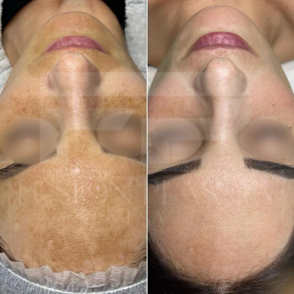Fusion Plasma, avant et après : hyperpigmentation du front atténuée