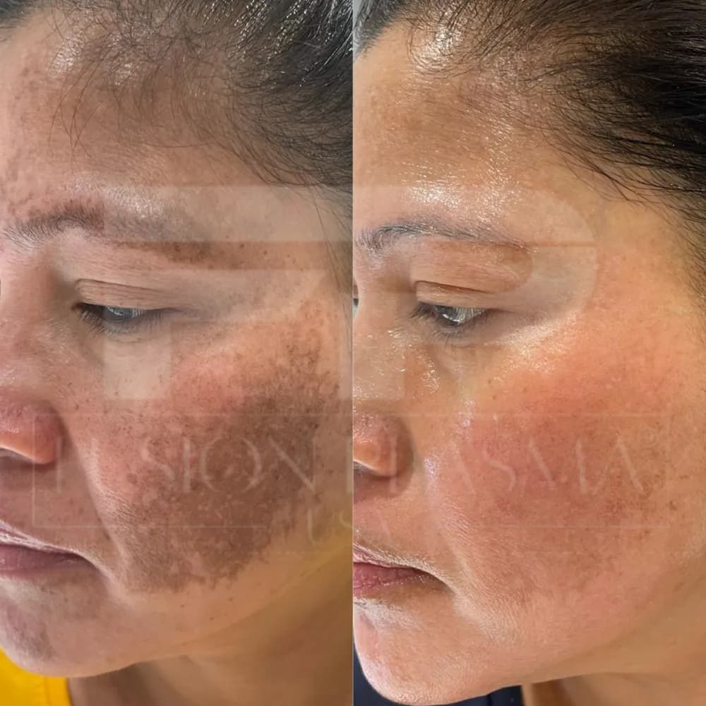 Fusion Plasma, avant et après : taches et rougeurs du visage atténuées