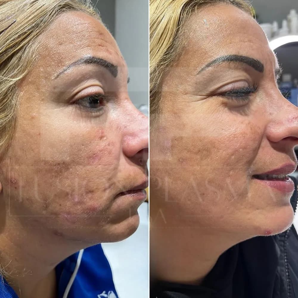 Fusion Plasma, avant et après : marques d’acné du visage atténuées