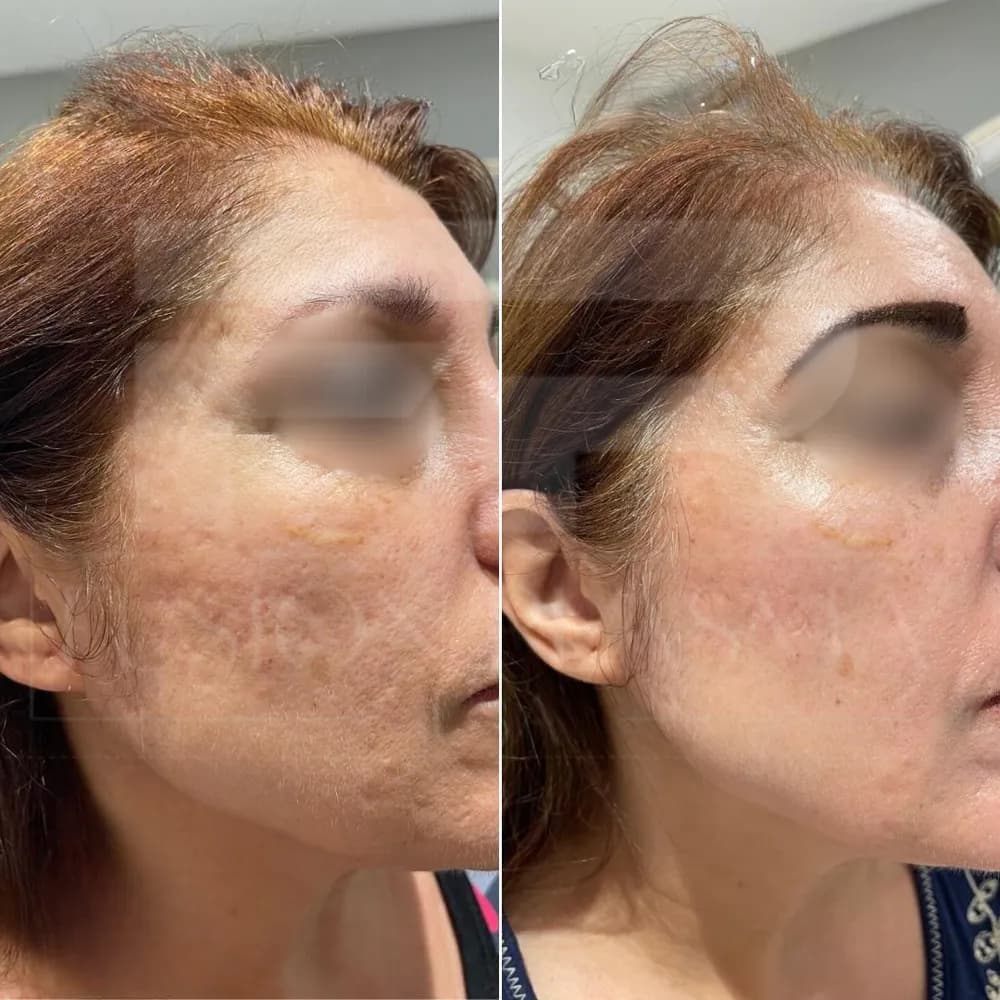 Fusion Plasma, avant et après : taches du visage, vues de profil